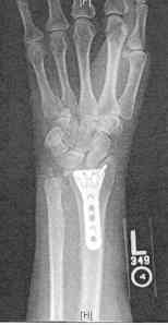 wristxray